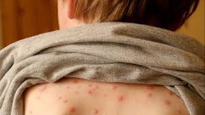Apr 18, 2021 · in addition, these patients can present rashes, hives, and acrocyanosis at all ages. Skin Rash Should Be Considered Key Symptom Of Coronavirus Say Scientists Itv News