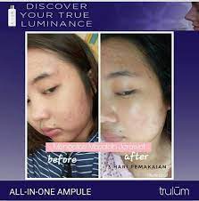 9jmspl4y4c5yym / entdecke rezepte, einrichtungsideen, stilinterpretationen und andere ideen zum ausprobieren. Jerawat Bertekuk Lutut Dengan Trulum Trulum Skincare 77 Facebook