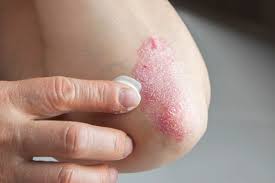 Quando a psoríase nos cotovelos tratamento deve ser iniciado imediatamente, até que a doença não se traduziu em mais graves e complexos fase. Psoriase Pode Acometer As Articulacoes