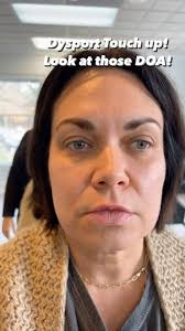2 week follow up! DOA needs touch up!, LOOK at her jawline!, #dysport  #eastcobb #eastmoms
