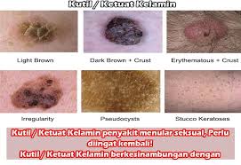 Aramanızda 5654 adet ürün bulundu. Jual Ubat Untuk Kutil Kelamin Di Farmasi Malaysia Kutil Kelamin Ubat Ketuat Kelamin