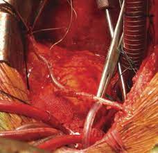 We did not find results for: The Right Internal Thoracic Artery The Forgotten Conduit 5 766 Patients And 991 Angiograms The Annals Of Thoracic Surgery