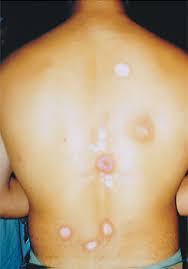 Similarly, radiation burns are one of the most common side effects of radiotherapy in patients with head and neck cancer. Radiation Burns Iaea Portable Digital Assistant For First Responders To A Radiological Emergency