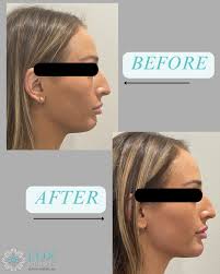 Understanding the difference between PDRN and PDGF is key to choosing the  right regenerative treatment for your skin.☺️ At our spa, we use trusted  brands like Rejuran and Ariessence to target specific