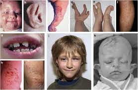 In these rare cases, it would be possible to have another child with the deletion. Goltz Gorlin Focal Dermal Hypoplasia And The Microphthalmia With Linear Skin Defects Mls Syndrome No Evidence Of Genetic Overlap European Journal Of Human Genetics