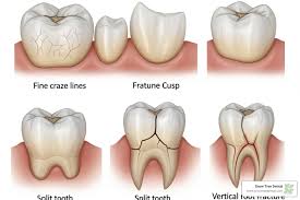 Image result for Tooth Fracture
