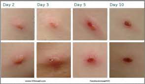 جدري الماء العنقز Chickenpox Dr Break دكتور بريك فيسبوك
