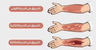 درجات الحروق حروق من الدرجة الثالثة