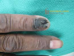 Image result for Acral lentiginous melanoma nail