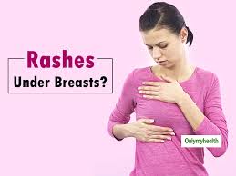 Image result for heat rash under breasts