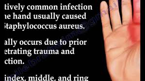 Image result for Hand Infection