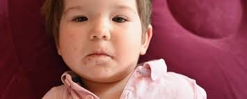 Image result for Impetigo