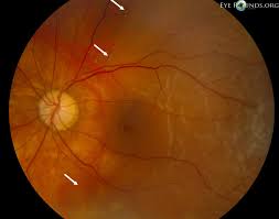 Allen reviews the symptoms of retinal detachment and 3 types of retinal detachment surgery | check out the eye floaters series. Vitreous Syneresis An Impending Posterior Vitreous Detachment Pvd