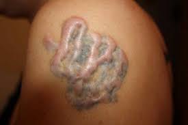 In this method, liquid nitrogen is applied to the keloid using a cotton swab or spray. Keloid Tattoo Facts Can Tattoos Cause Keloids Authoritytattoo