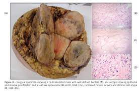 Malignant phyllodes tumors (mpt) have a poor prognosis, with most patients dying within 3 years after starting treatments 1. Scielo Brazil Malignant Phyllodes Tumor Of The Breast Case Report Malignant Phyllodes Tumor Of The Breast Case Report