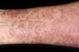 You can also apply medicated cream to ease the discomfort of your symptoms. Bullous Pemphigoid Nhs