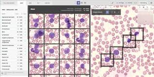 Image result for Peripheral Smear
