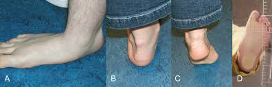 Der knicksenkfuß ist einer der häufigsten gründe, der zur vorstellung von kindern beim orthopäden führt. Orthoforum Flexibler Knicksenkfuss