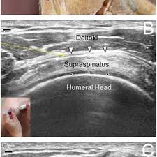 Image result for Subacromial Space Injection