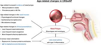 Nasal polyp — ▪ anatomy lump of tissue that protrudes into the nasal cavity and sometimes obstructs it. Chronic Rhinosinusitis With Nasal Polyps In Older Adults Clinical Presentation Pathophysiology And Comorbidity Springerlink