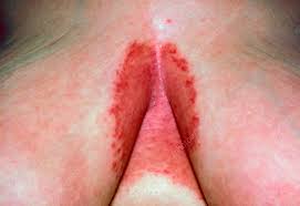 Image result for Intertrigo under breasts