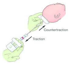 Image result for Vacuum Caput