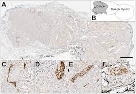 There are a number of different treatments doctors recommend. Innervation Of Papillary Thyroid Cancer And Its Association With Extra Thyroidal Invasion Scientific Reports