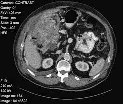 Ct images of malignant peritoneal mesothelioma with the liver involvement typically showed that the lesion grew . Peritoneal Mesothelioma A Case Report Sciencedirect