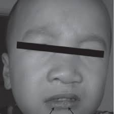 Genogram of the two families. (A) VWS family 1 and (B) VWS family 2....