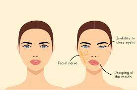 They may include muscle twitching, weakness, or total loss of the ability to move one, and in rare cases, both sides of the face. Bell S Palsy Yang Tidak Ditangani Sebabkan Ulkus Kornea