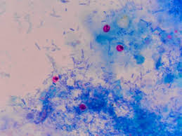 Cryptosporidium, sometimes informally called crypto, is a genus of apicomplexan parasitic alveolates that can cause a respiratory and gastrointestinal illness (cryptosporidiosis) that primarily involves watery diarrhea (intestinal cryptosporidiosis) with or without a persistent cough (respiratory cryptosporidiosis). Modified Ziehl Neelsen Stain For Cryptosporidium Diapath
