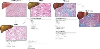 Diagnostic Challenges Of Nonalcoholic Fatty Liver Disease