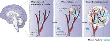 Brain Metastases As Preventive And Therapeutic Targets Nature Reviews Cancer