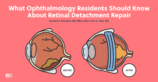 Retinal detachment can be mitigated in some cases when the warning signs 8 are caught early. What Ophthalmology Residents Should Know About Retinal Detachment Repair Eyes On Eyecare