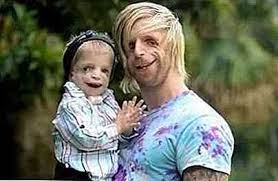 Die wiederherstellung von form und funktion beim treacher collins. Treacher Collins Syndrom Symptome Ursachen Behandlungen Thpanorama Heute Besser Werden