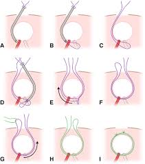Image result for Inguinal hernia child