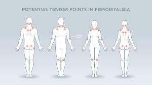 Fibromyalgia is currently understood to be a disorder of central pain processing or a syndrome of central sensitivity. The Neuroscience Of Fibromyalgia Causes Diagnosis And Potential Treatments Technology Networks