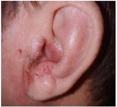 Image result for Acute Otitis Externa