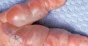 Image result for pompholyx soles of feet