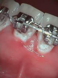 Best methods to remove plaque on braces. Tooth Plaque Cheek Dental Blog