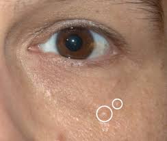 Image result for milium cyst on eyelid