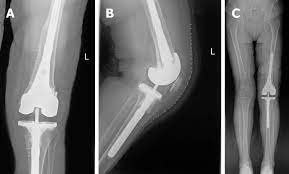 This condition occurs when the cartilage here are seven signs that the time might be right for a knee replacement: Re Revision Surgery For Re Recurrent Valgus Deformity After Revision Total Knee Arthroplasty In A Patient With A Severe Valgus Deformity A Case Report