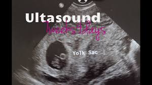 At 10 weeks gestation she's around 3cm. 7 Week 4 Day Scan Of Baby Lucky Youtube