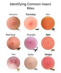 Image result for mosquito bite