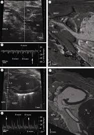 Position refers to whether the fetus is facing rearward (toward the woman's back—that is, face down when the woman lies on her back) or forward (face up). Micro Ultrasound For Preclinical Imaging Interface Focus