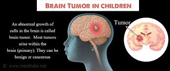 Brain tumors, either malignant or benign, are tumors that originate in the cells of the brain. Brain Tumor In Children Types Causes Symptoms Diagnosis Treatment