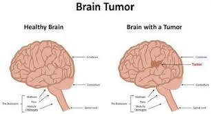 Bigger brains have more brain cells, and thus a greater potential for cell mutations that lead to cancer. World Brain Tumour Day 2019 Here Is How To Fix The Side Effects Of Treatment Thehealthsite Com