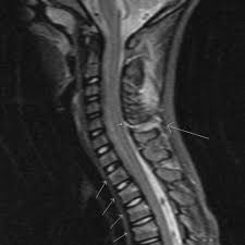 The ligamentum nuchae are very strong. Posterior Ligamentous Injury Of The Cervical Spine Eurorad