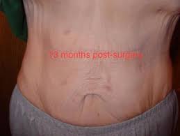 A severe infection develops that can lead to sepsis (adverse symptoms involving all. Scars From Gastric Sleeve Surgery How Your Stomach Will Look Bariatric Surgery Source