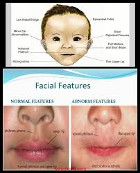 Round face with full cheeks; Fetal Alcohal Syndrome Microcephaly Fetal Alcohol Syndrome Fetal Alcohol Microcephaly